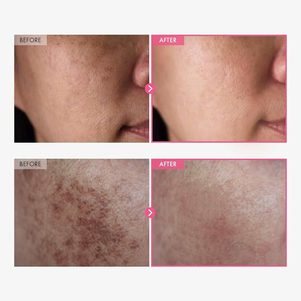 Korean Brightening Cream - Arbutin 7% + Tranexamic Acid 4% Cream